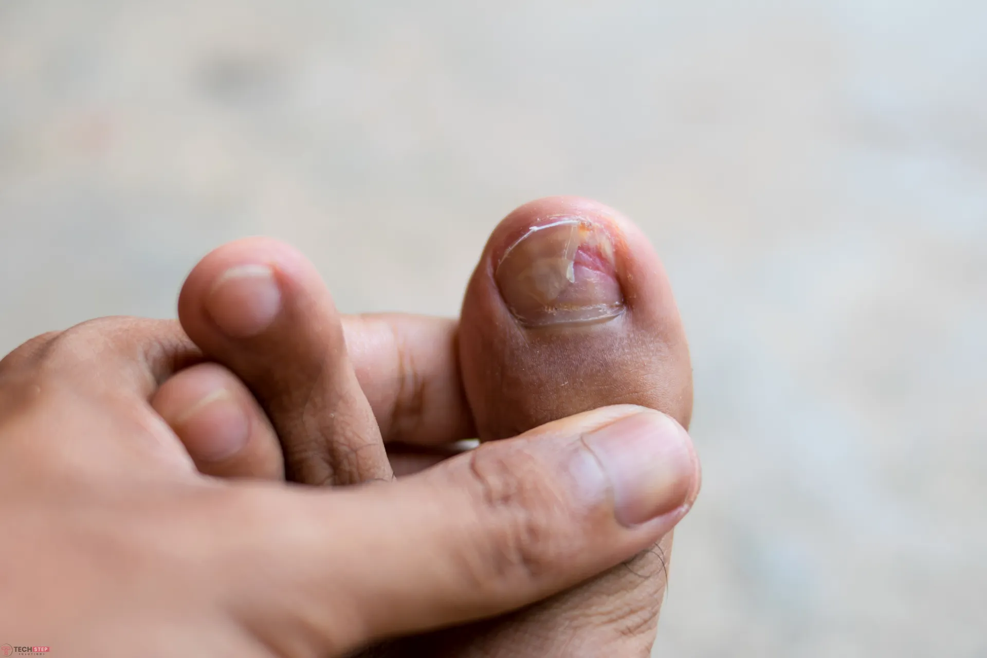 How to Get Rid of Thick Toenails
