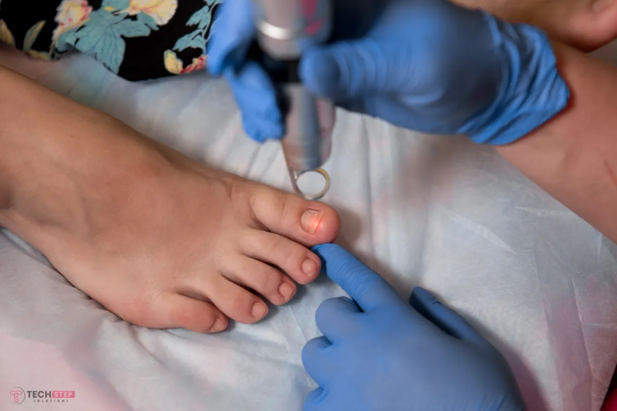 Laser Solutions for fungul nail