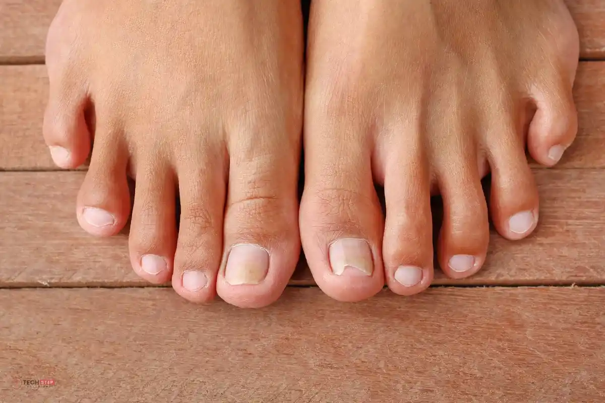Results After Laser Treatment