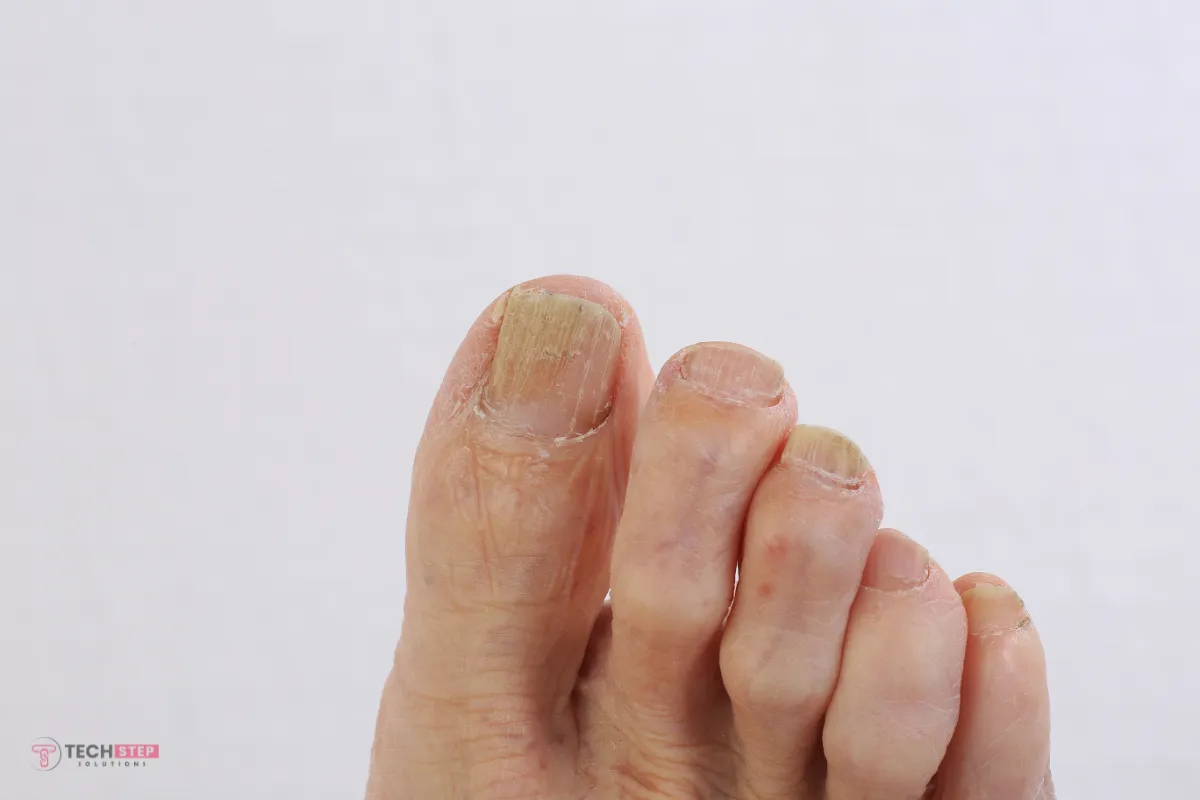 Toenail Fungus Treatment in Irvine