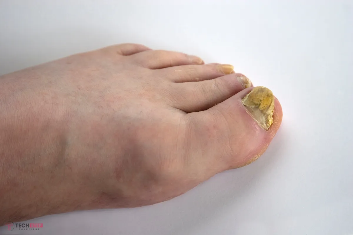 Toenail Fungus Treatment in Lake Forest