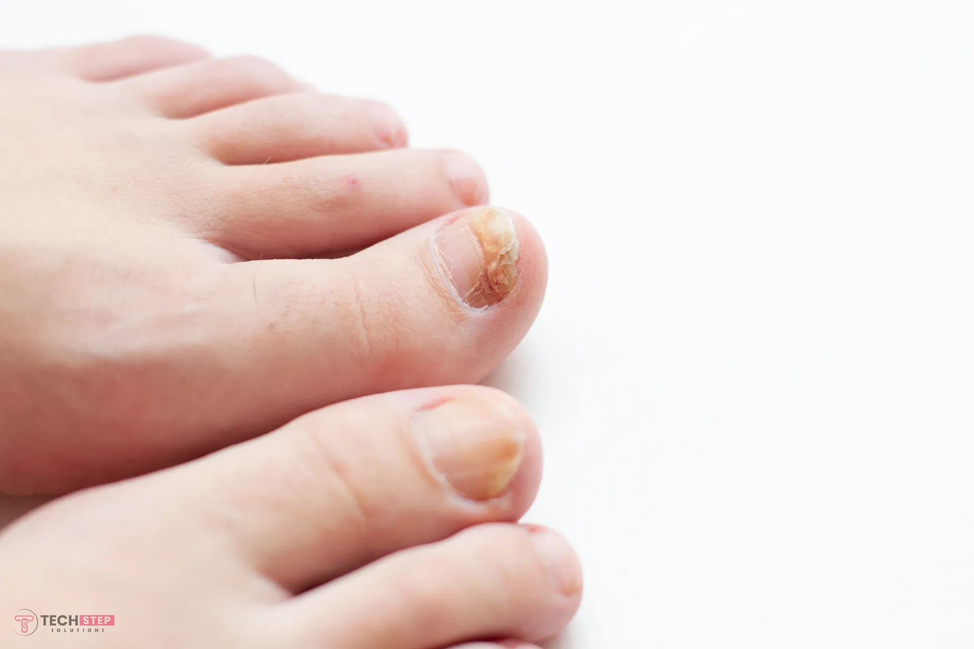 What Is the Best Toenail Fungus Treatment