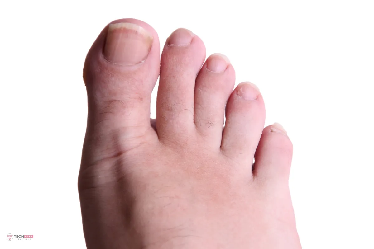 aftercare protocol of toenail