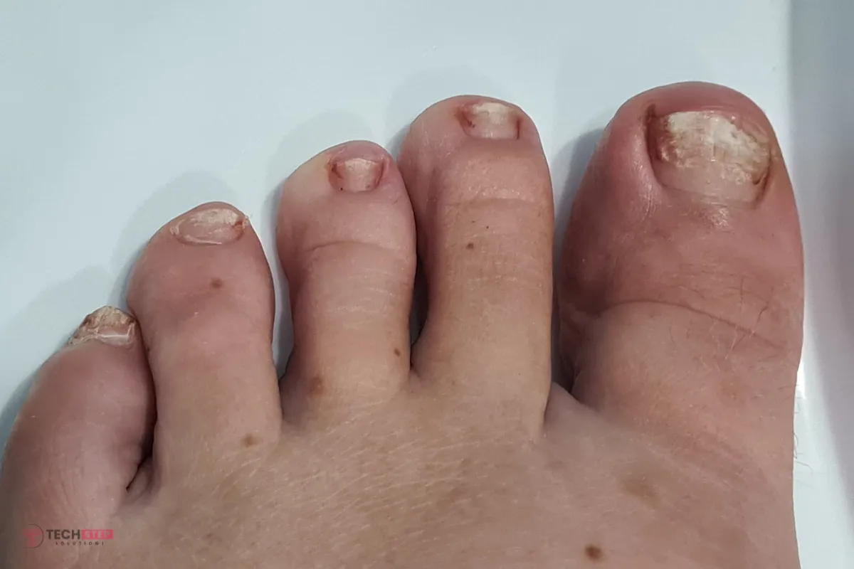 fungal nail treatment