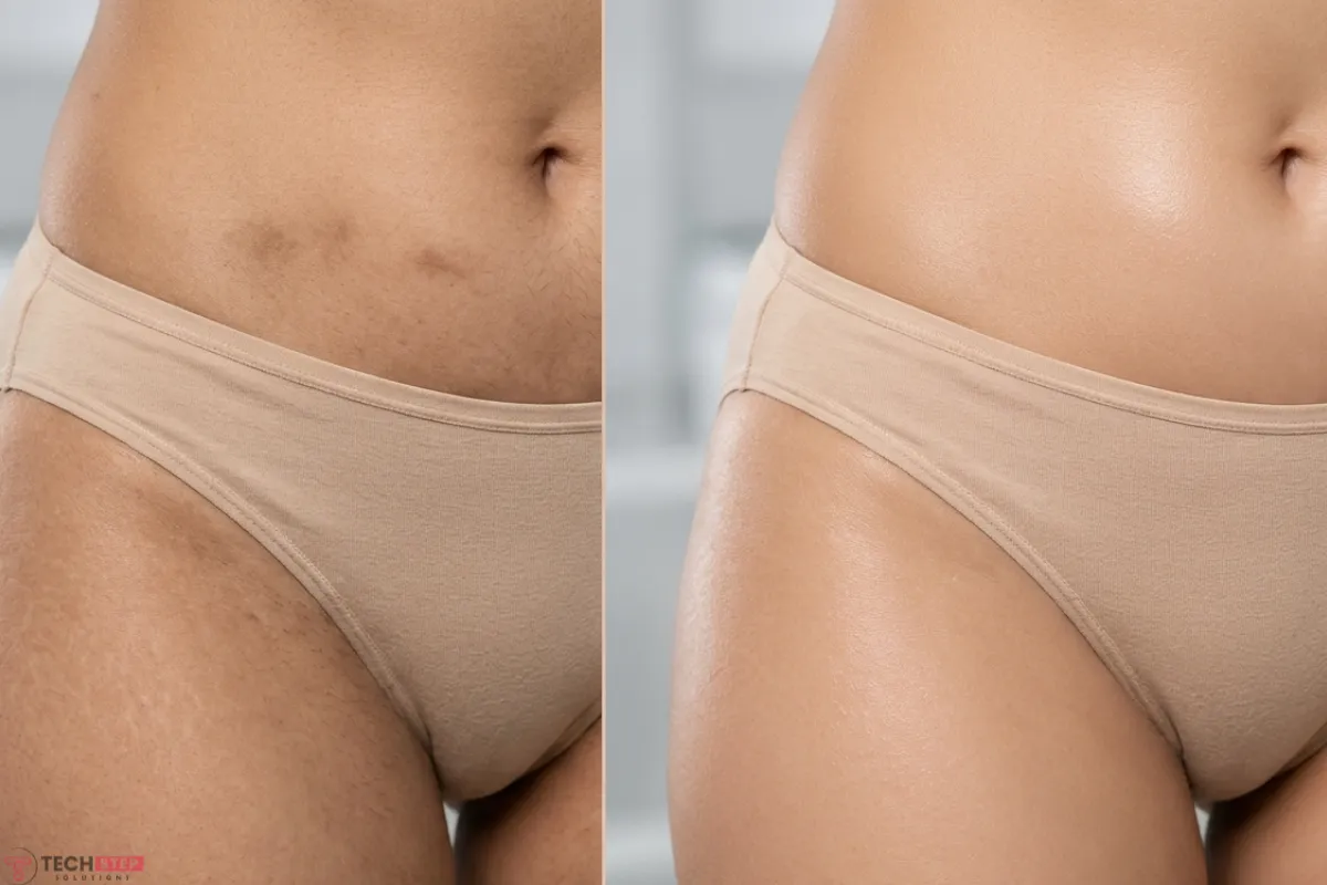 intimate bleaching before after