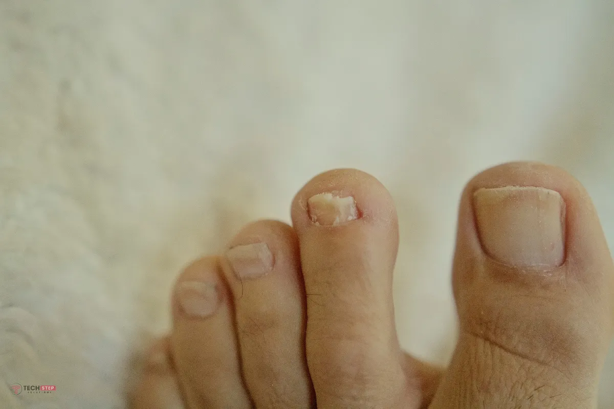laser nail treatment