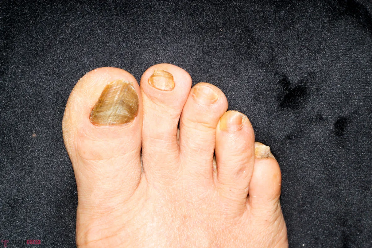 thick toenail treatment