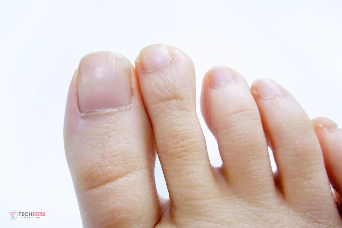 toenail fungus laser treatment