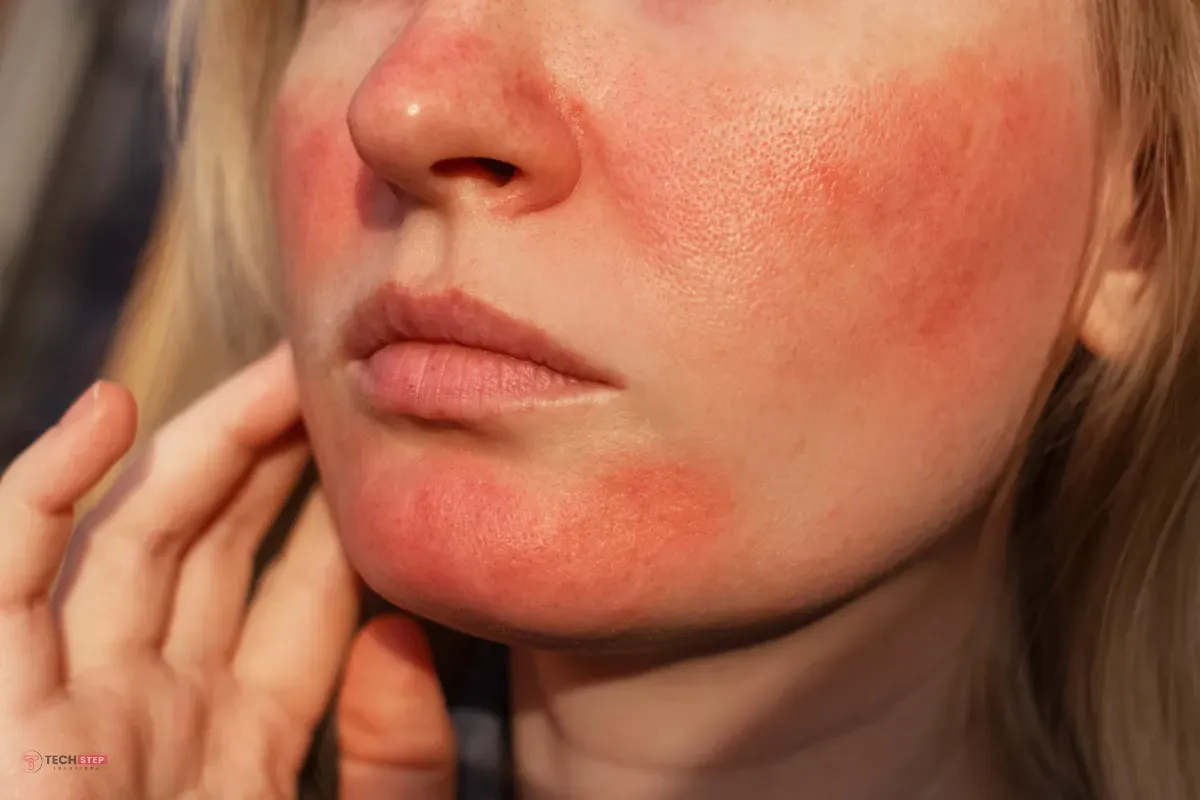 IPL to reduce skin redness