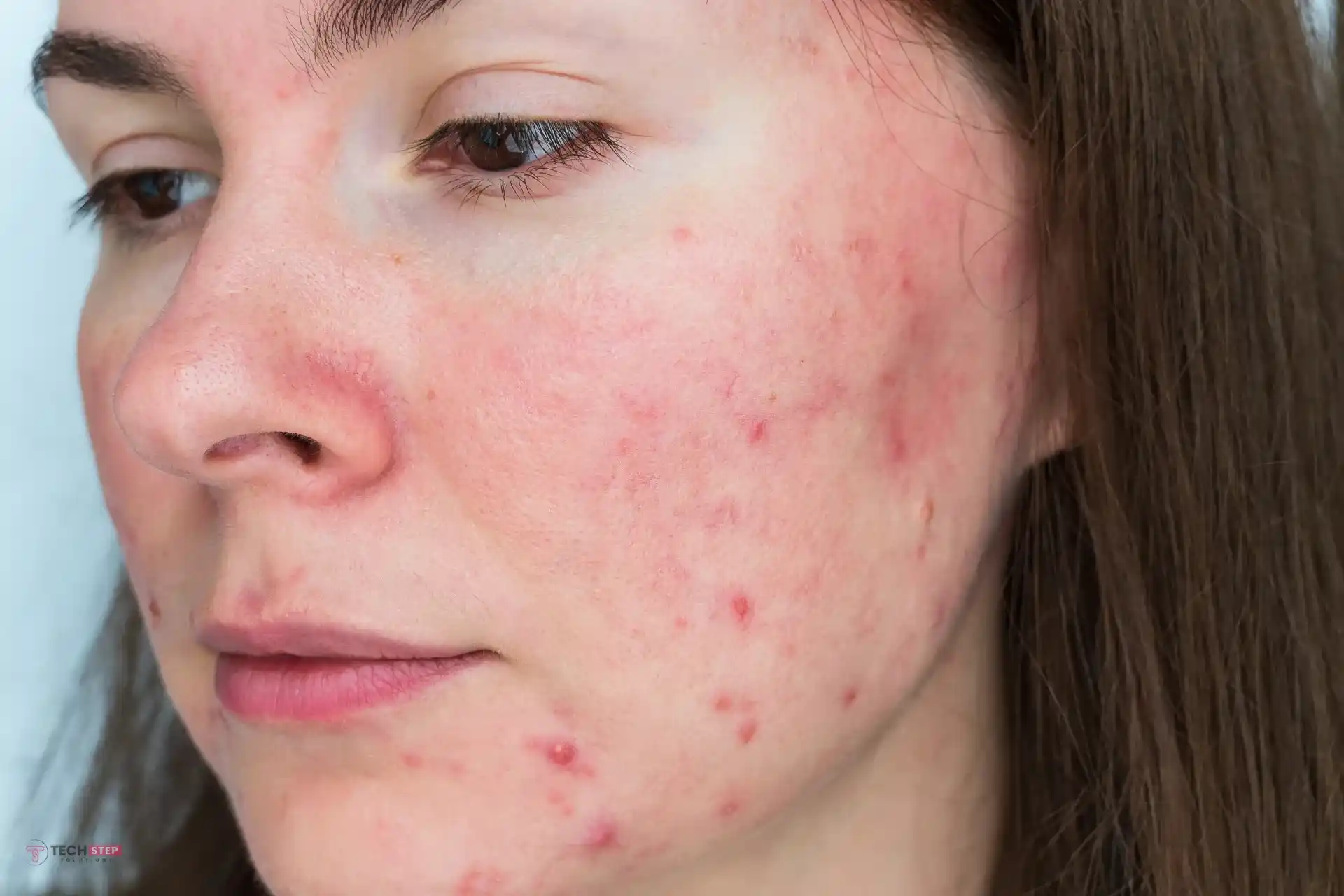 Laser Treatment for Rosacea Near Me