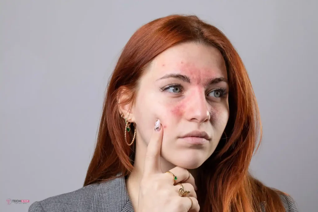 Laser Treatment for Rosacea in Orange County