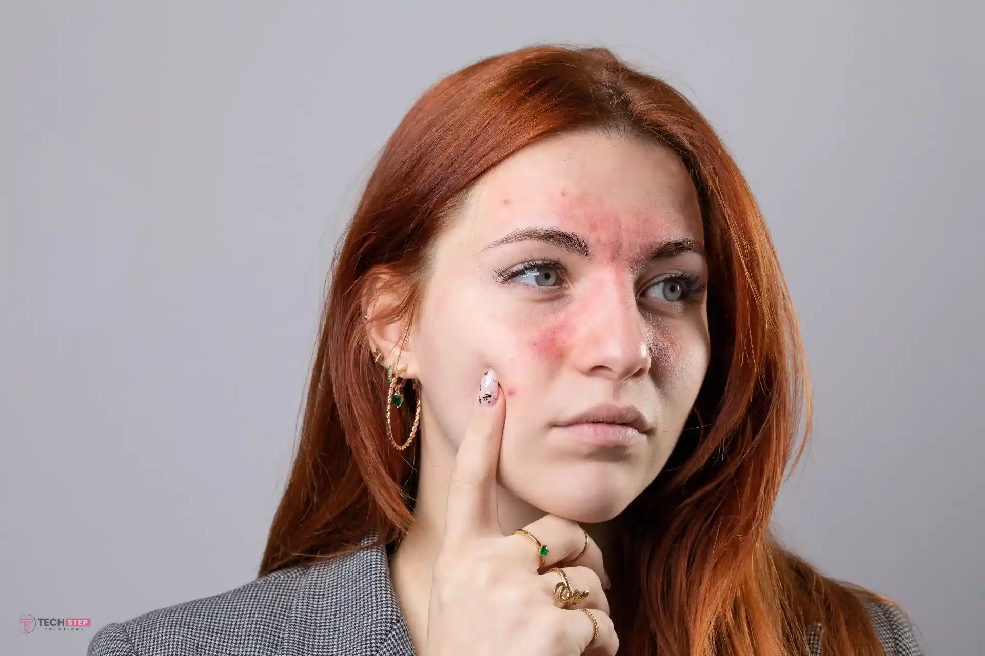 Laser Treatment for Rosacea in Orange County