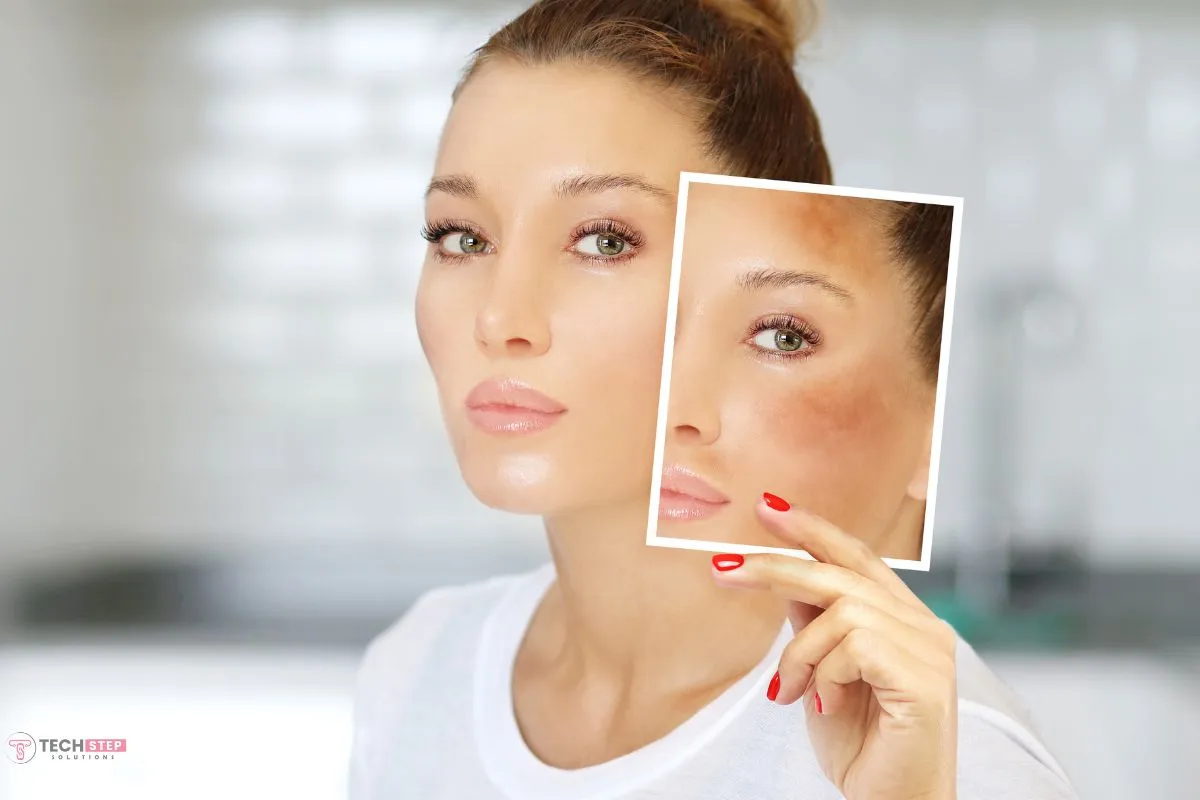 Melasma Treatment in Orange County