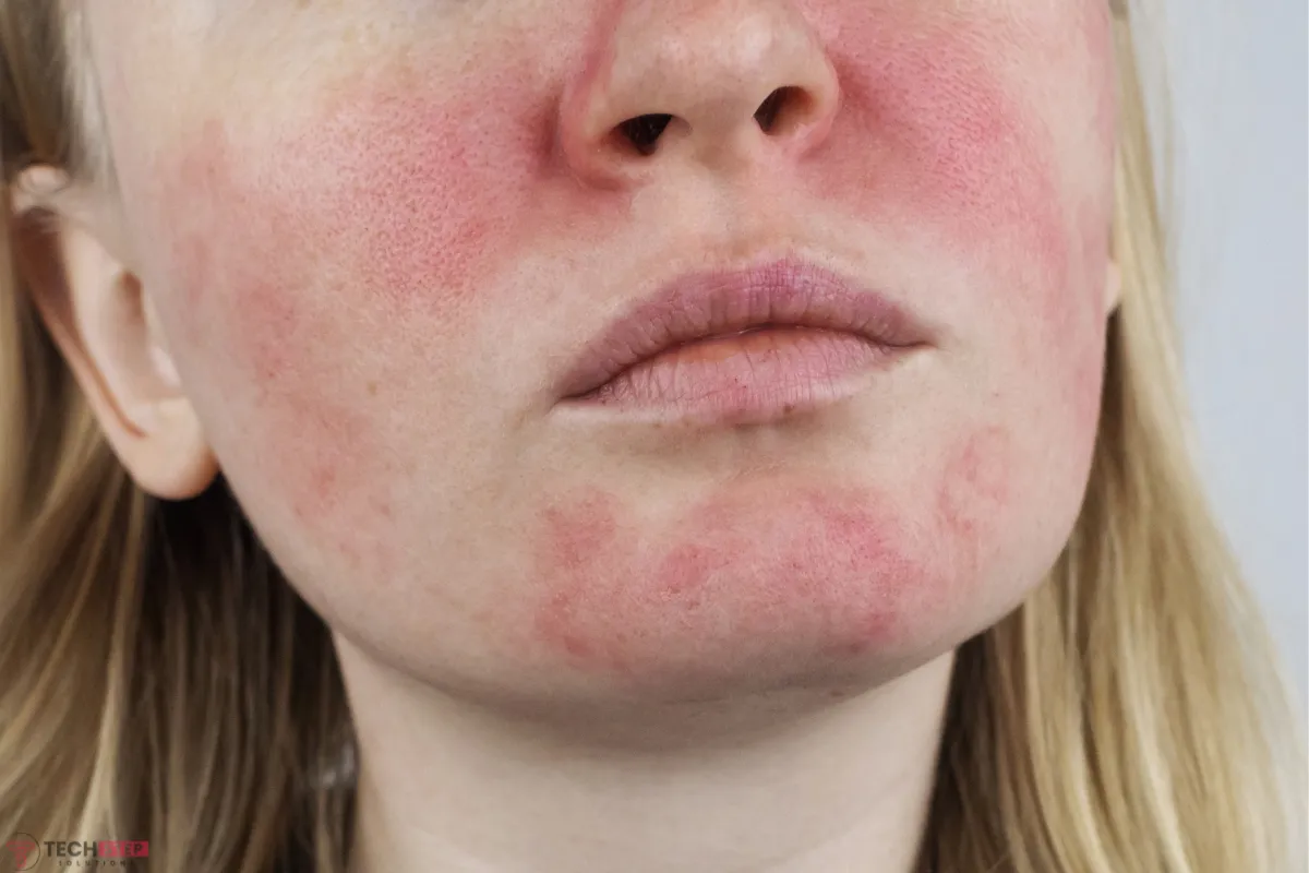 Rosacea Treatment