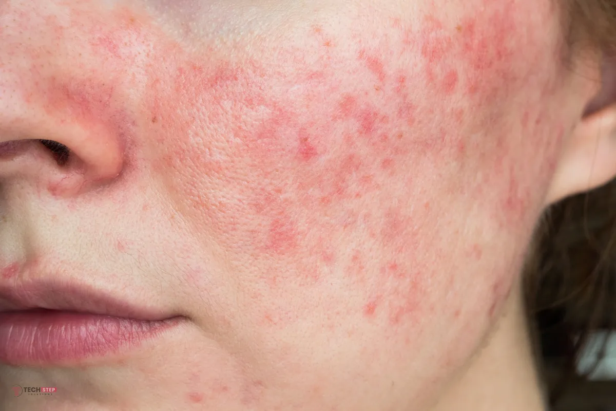 Rosacea Treatment in Irvine