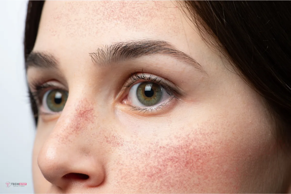 Rosacea Treatment