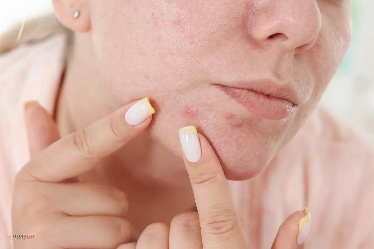 Rosacea in Its Early Stages