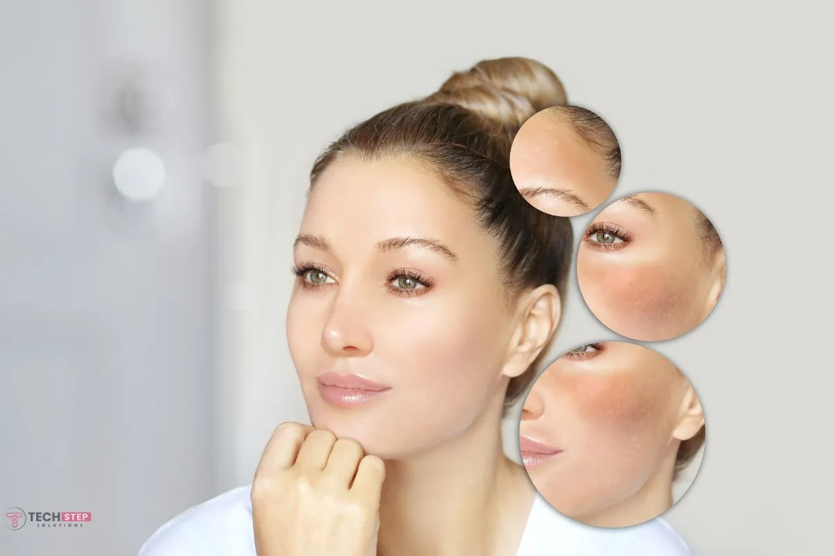 Satisfied client of melasma removal