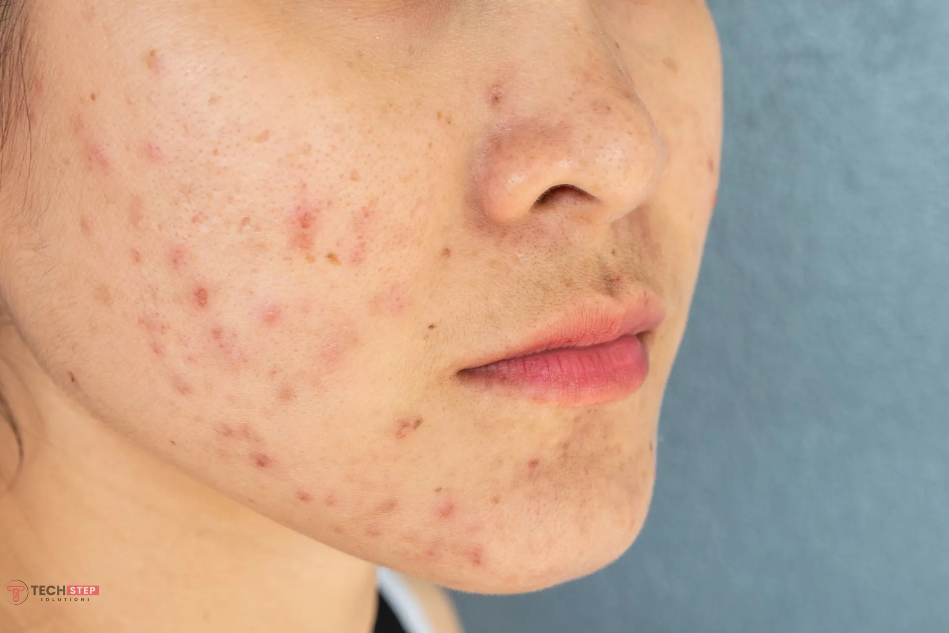 Spots and Redness on Face Treatment