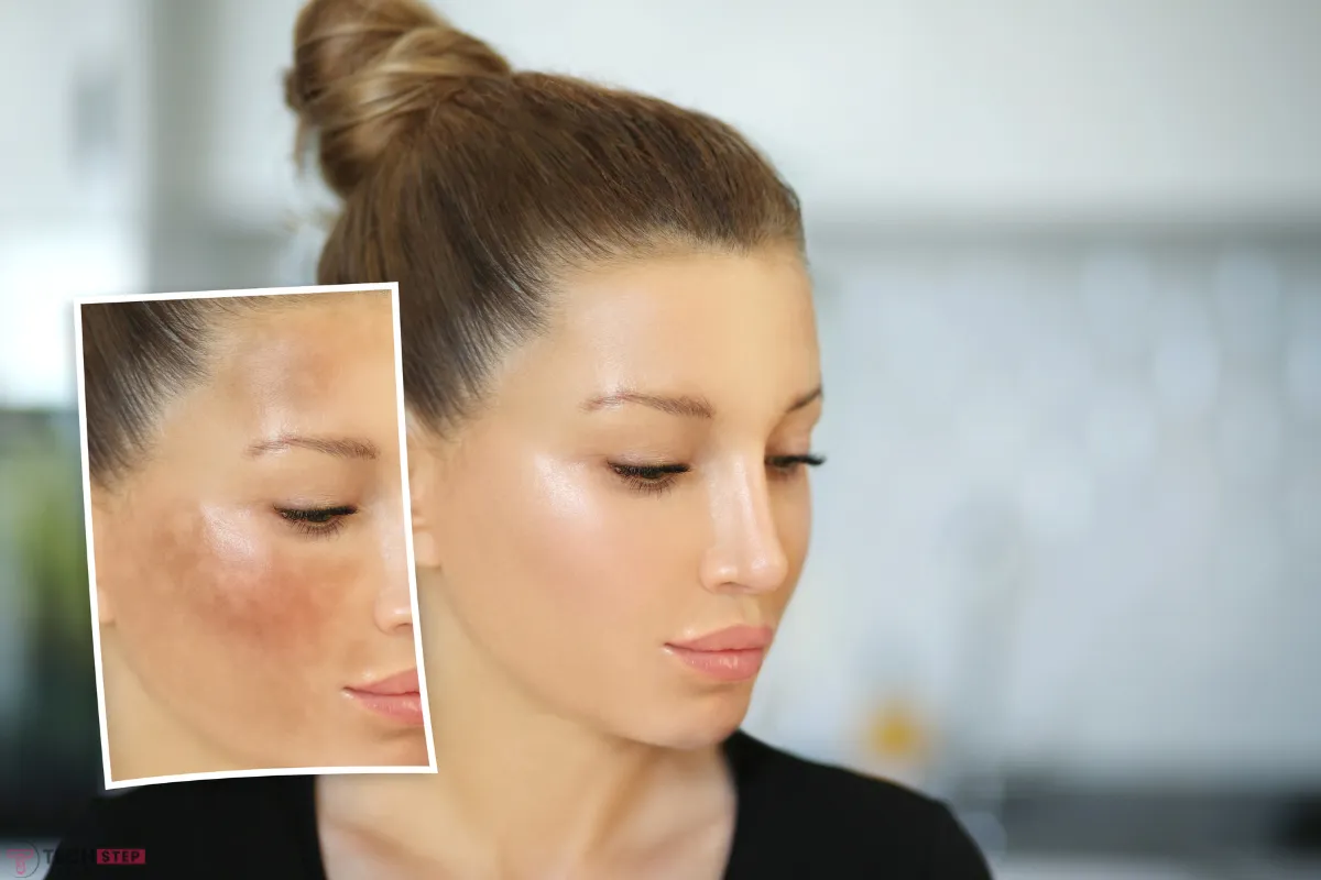 Sun Spots on Skin