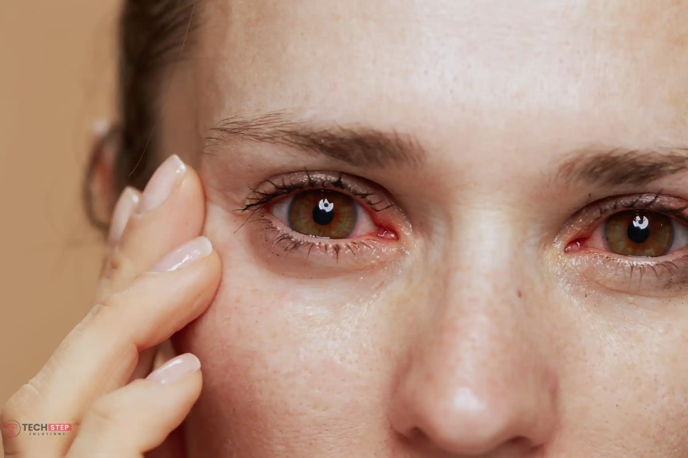 rosacea eyes treatment to reduce redness and irritation