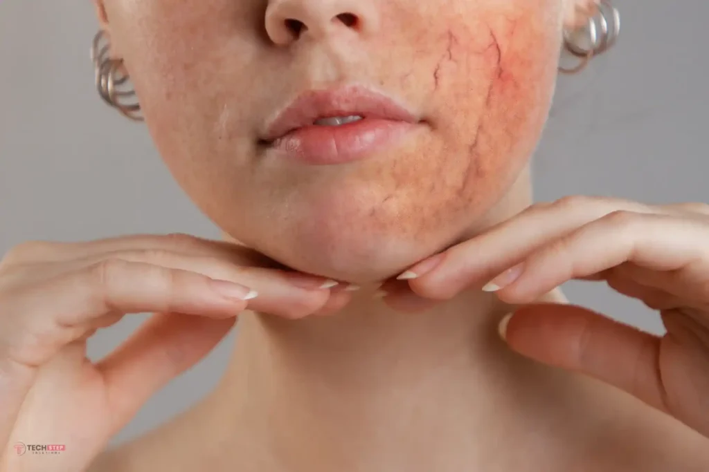 rosacea redness laser treatment in orange county