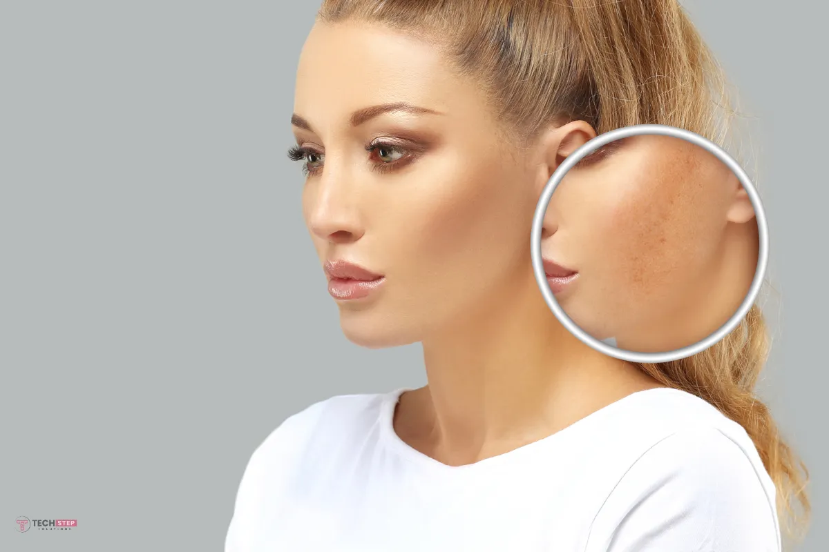 Hyperpigmentation Laser Treatment near me
