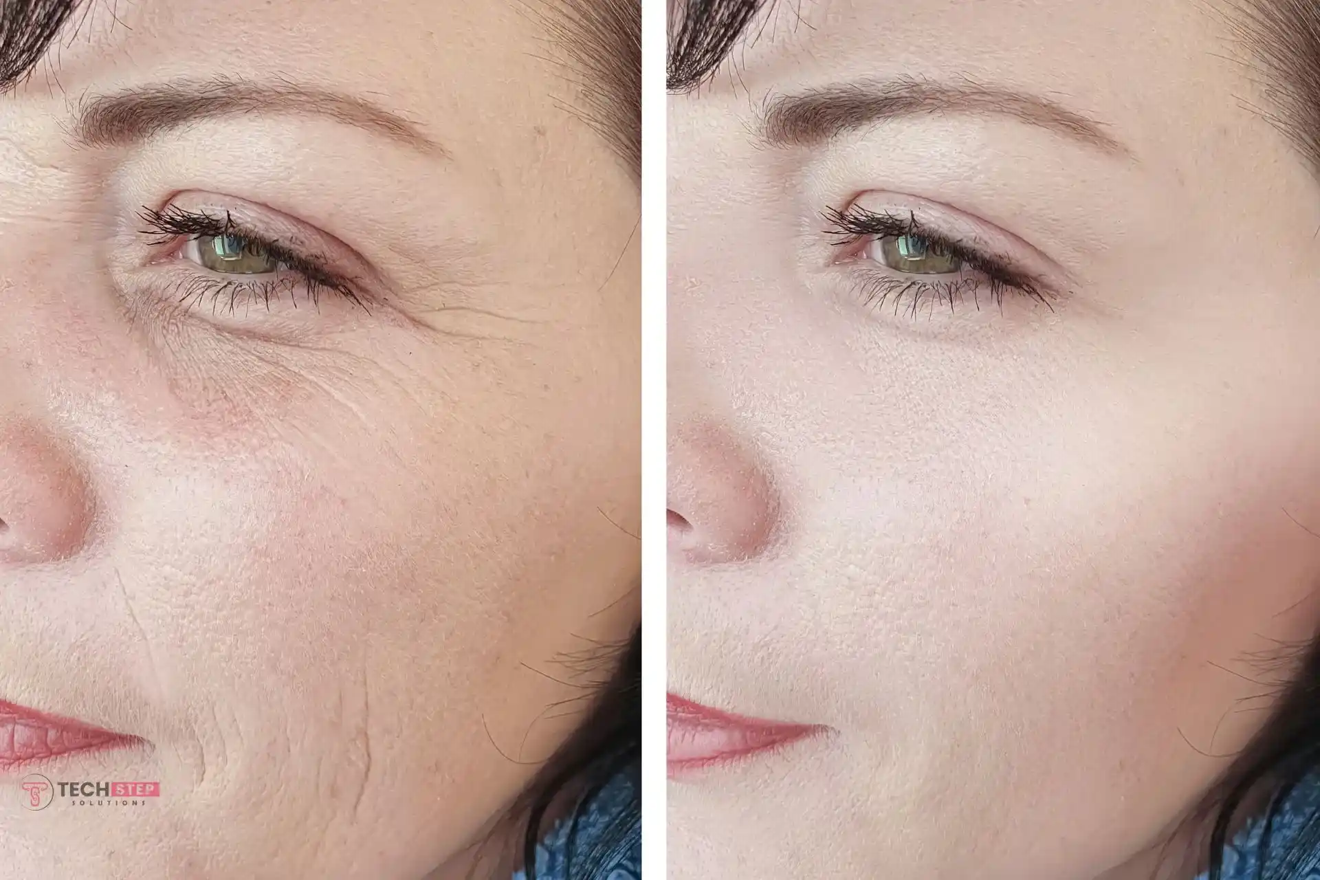 laser treatment rosacea before and after results for facial redness