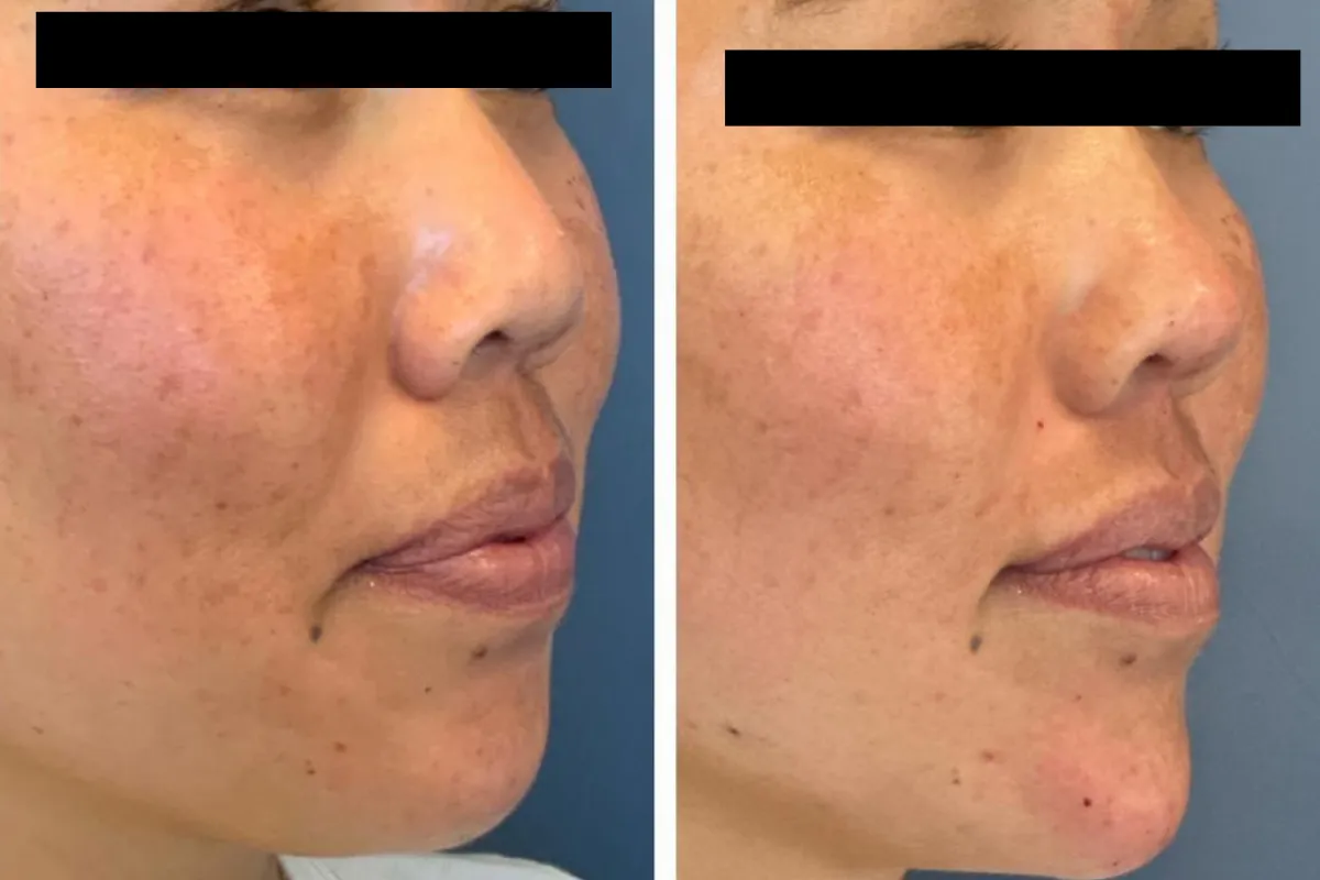 Before and After Dermal Filler Treatment orange county