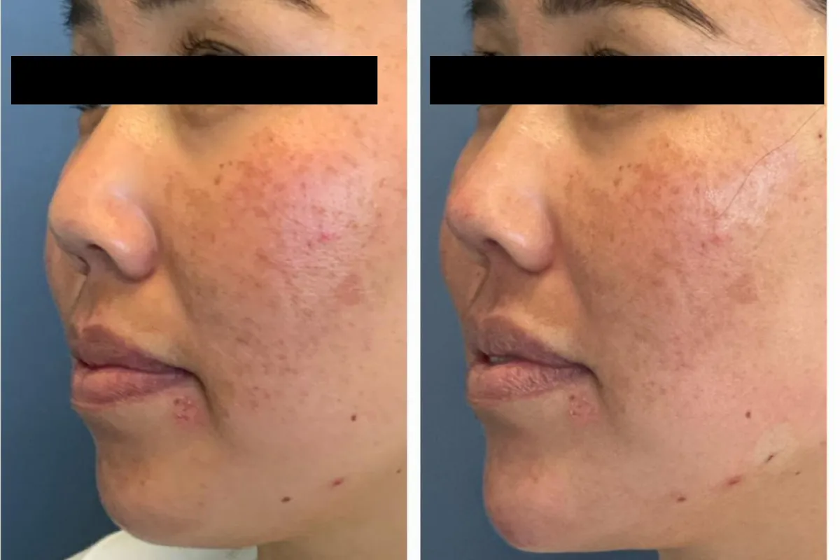 Before and After juvederm Session