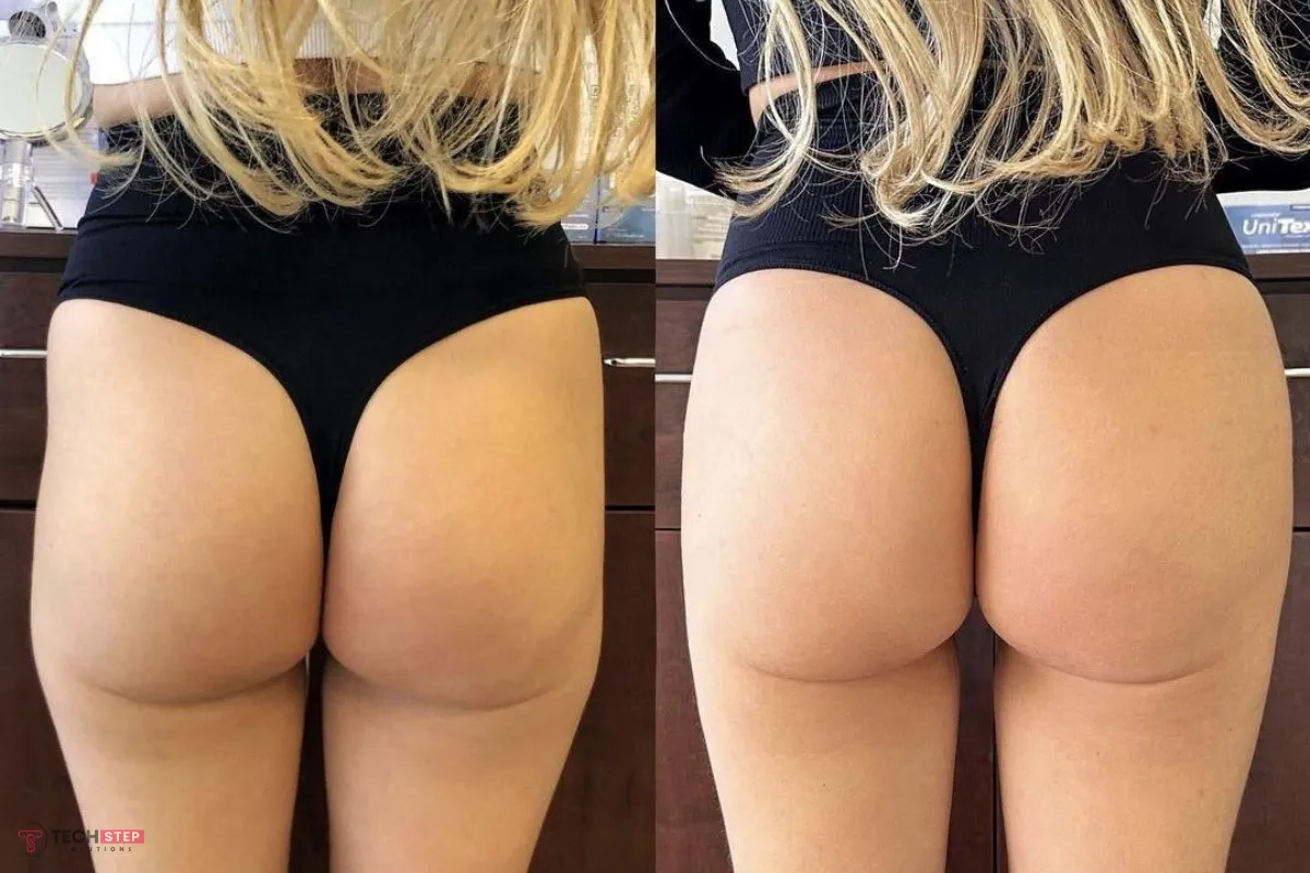 Butt Lift in Orange County