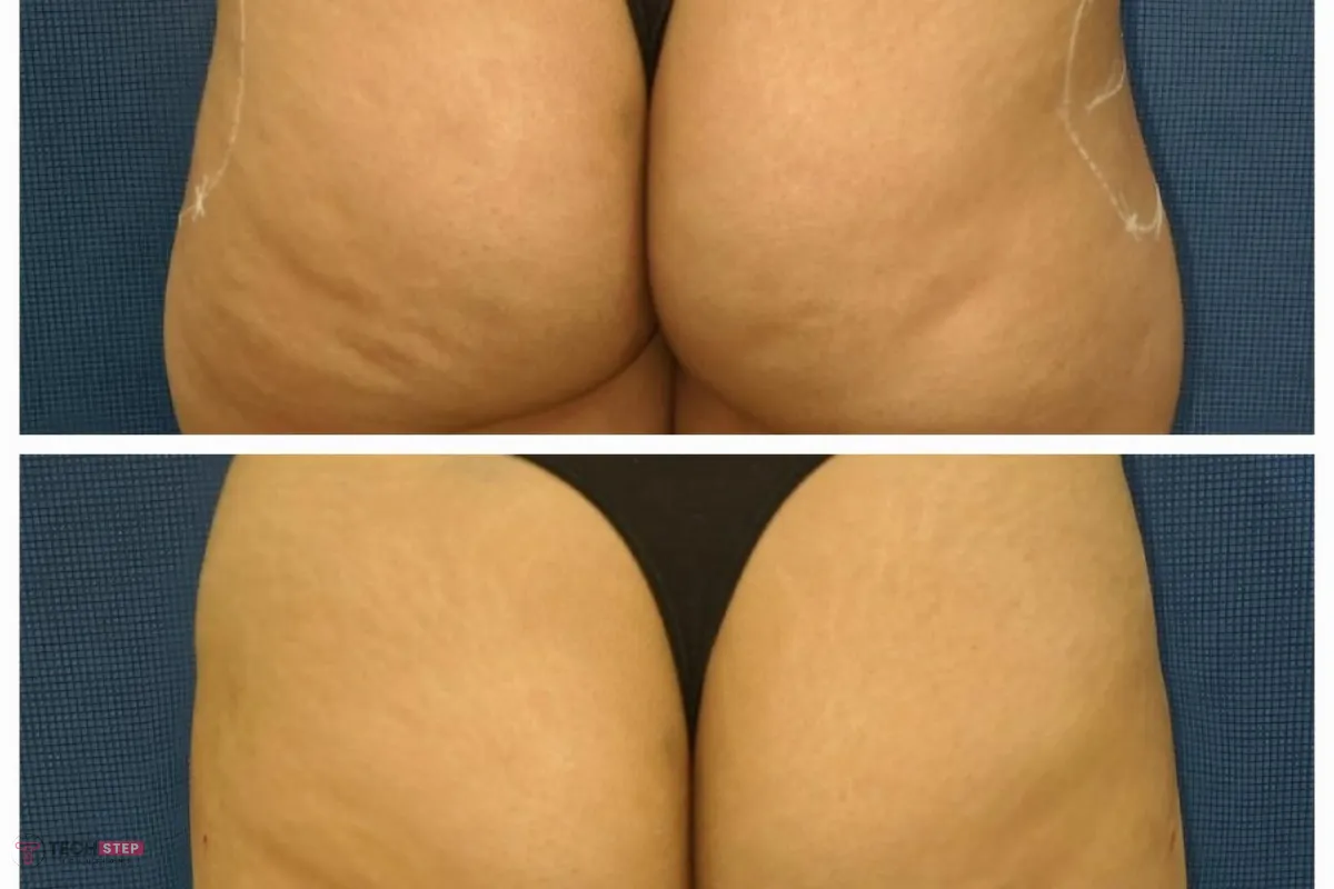 butt lift benefit