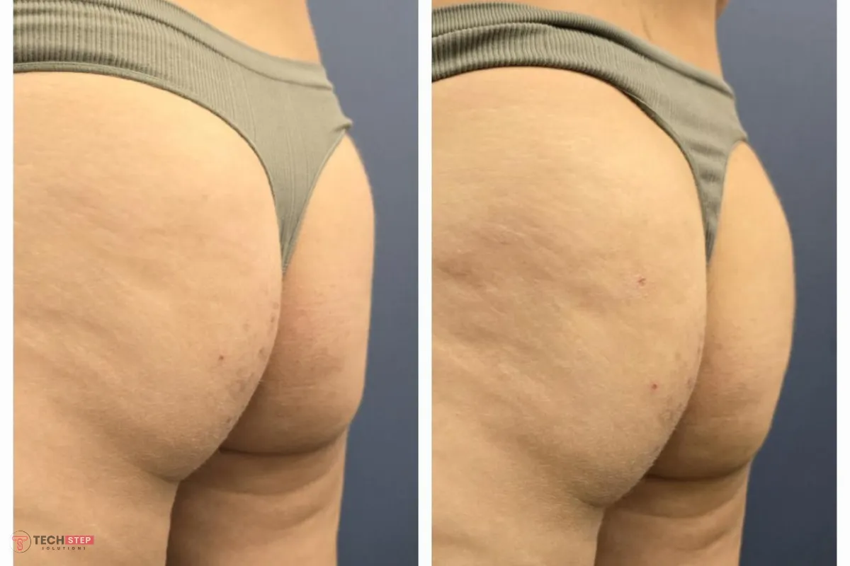 ideal candidate of butt lift