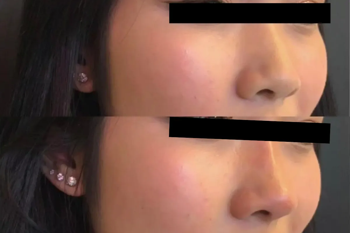top advantages of dermal filler
