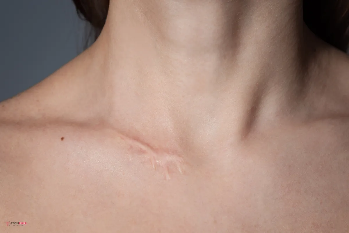 Lake Forest Scar Treatment