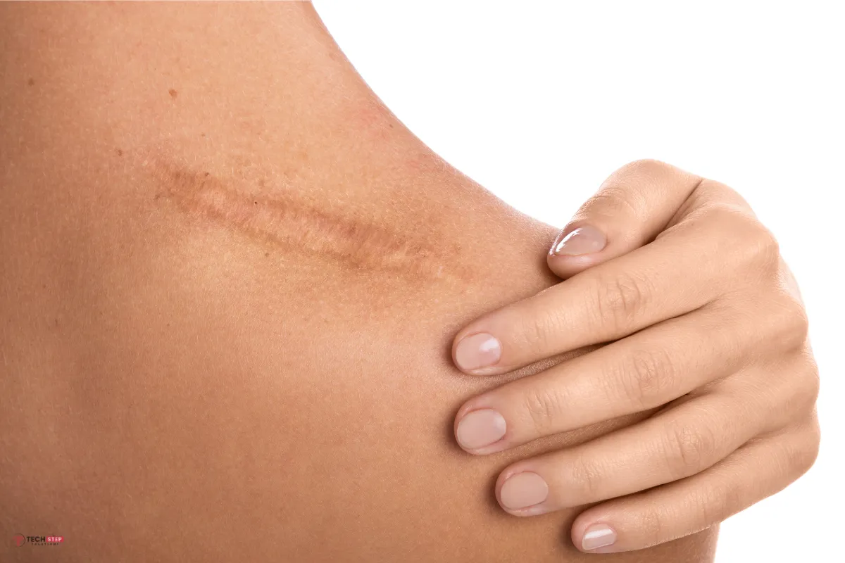 Scar Removal