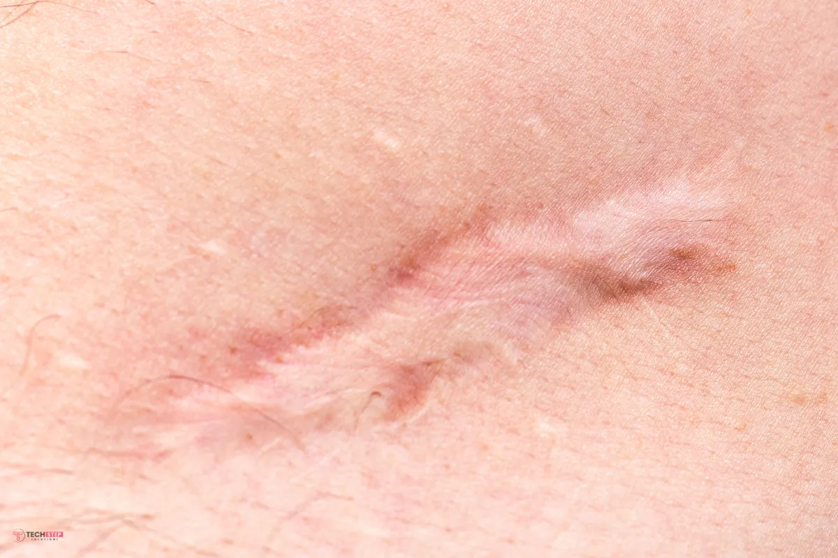 Scar Treatment Results