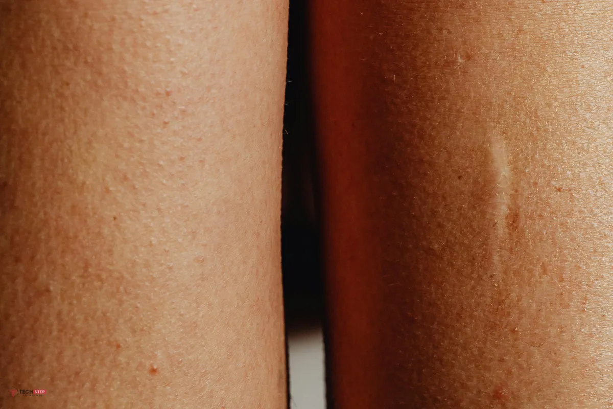 Smooth Skin Treatment