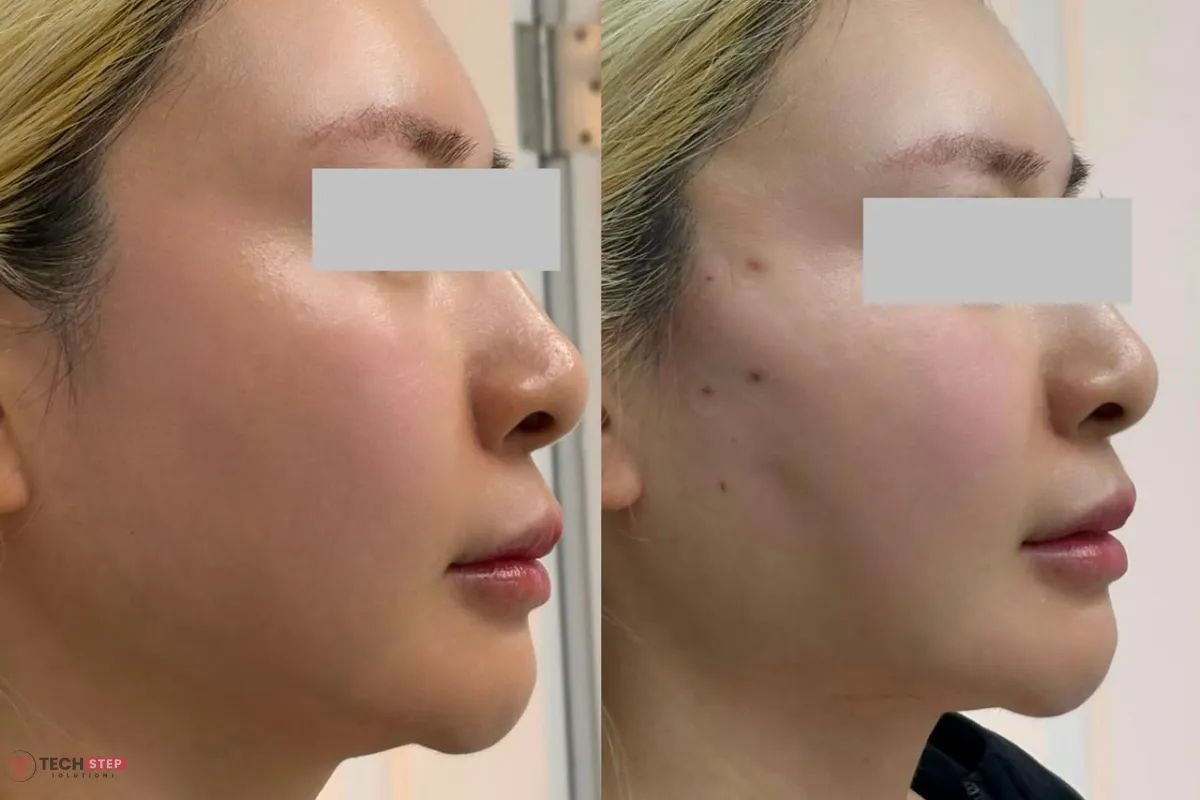 good candidate of pdo thread lift