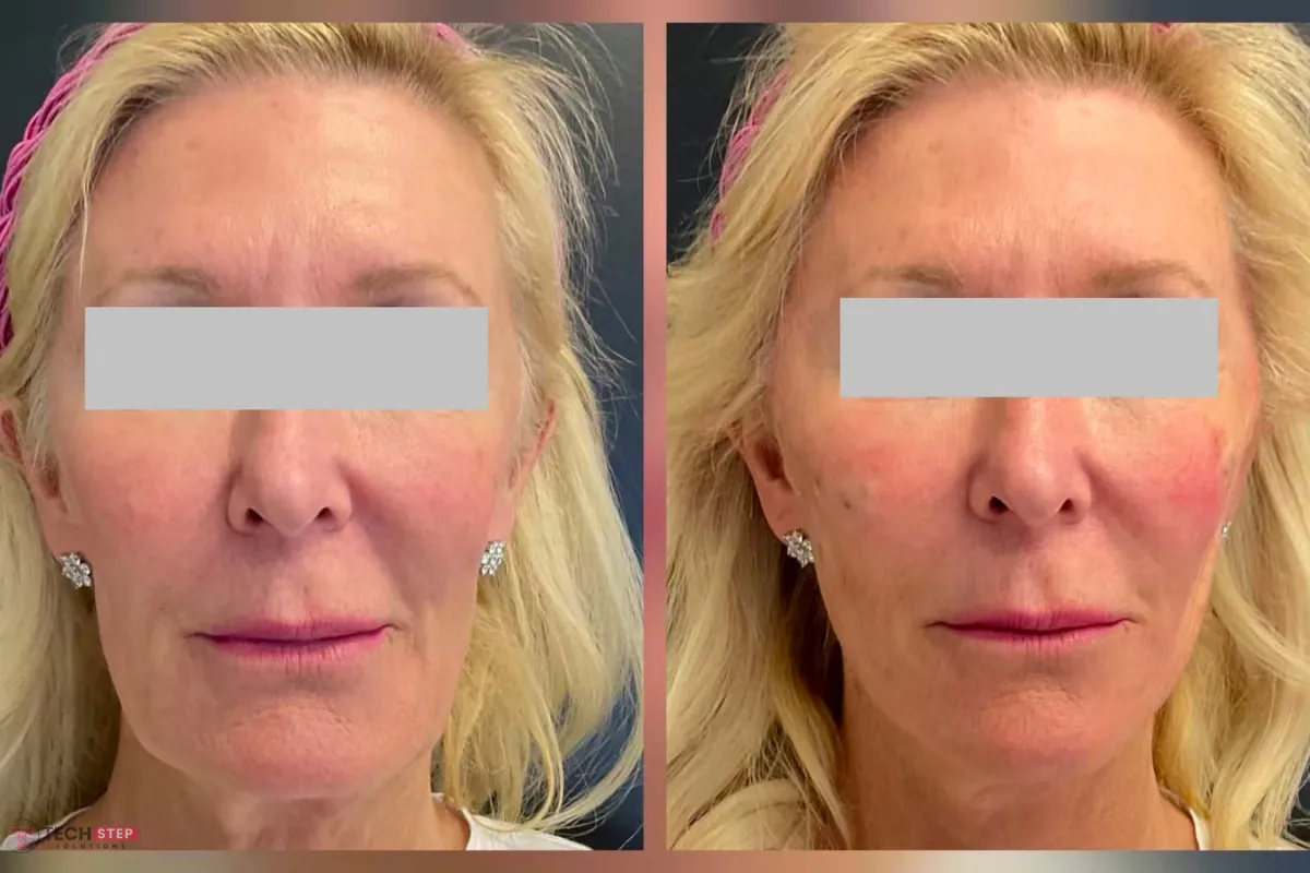 pdo thread lift benefits
