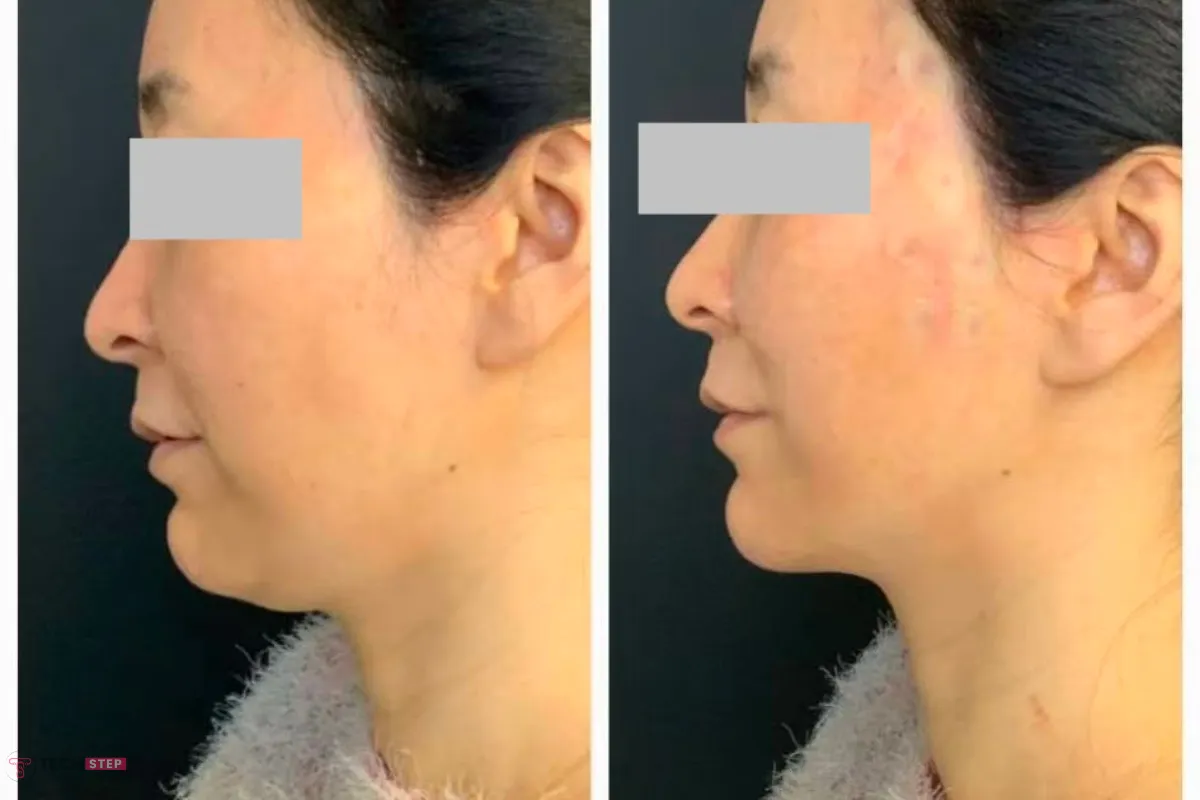 thread lift procedure process