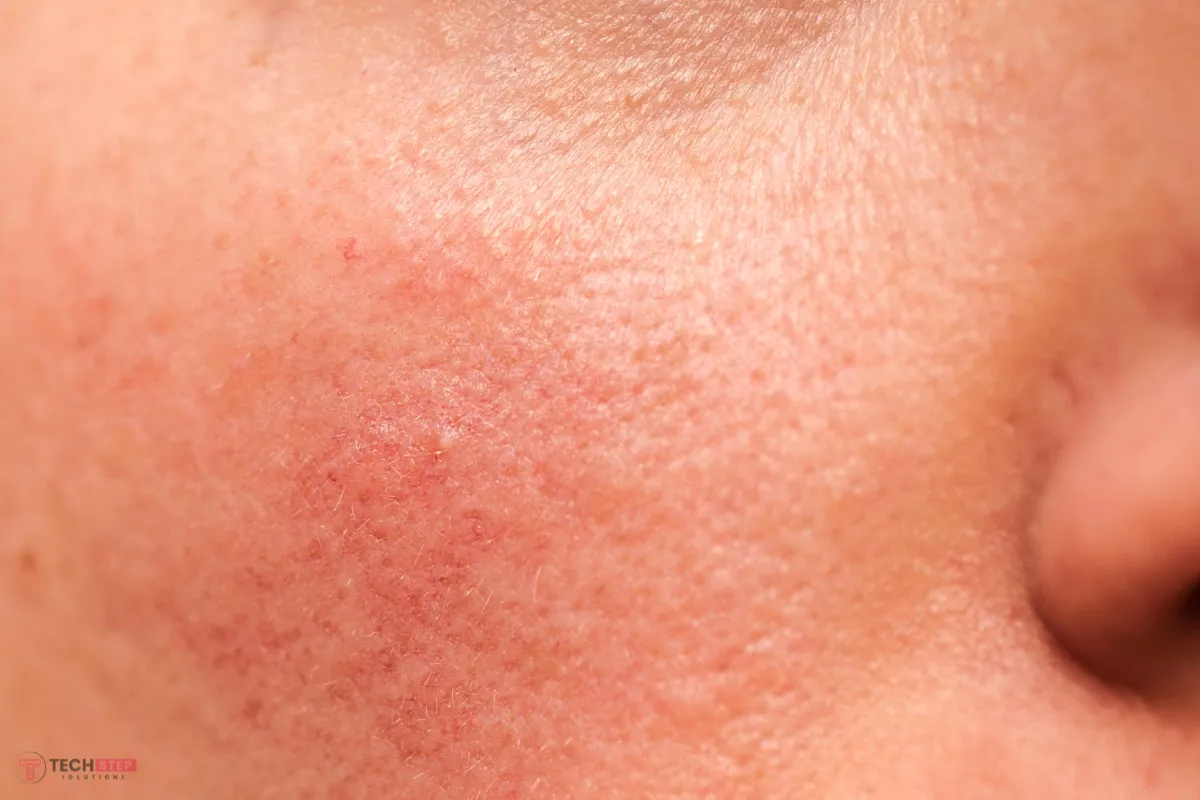 Keratosis pilaris skin consultation and care