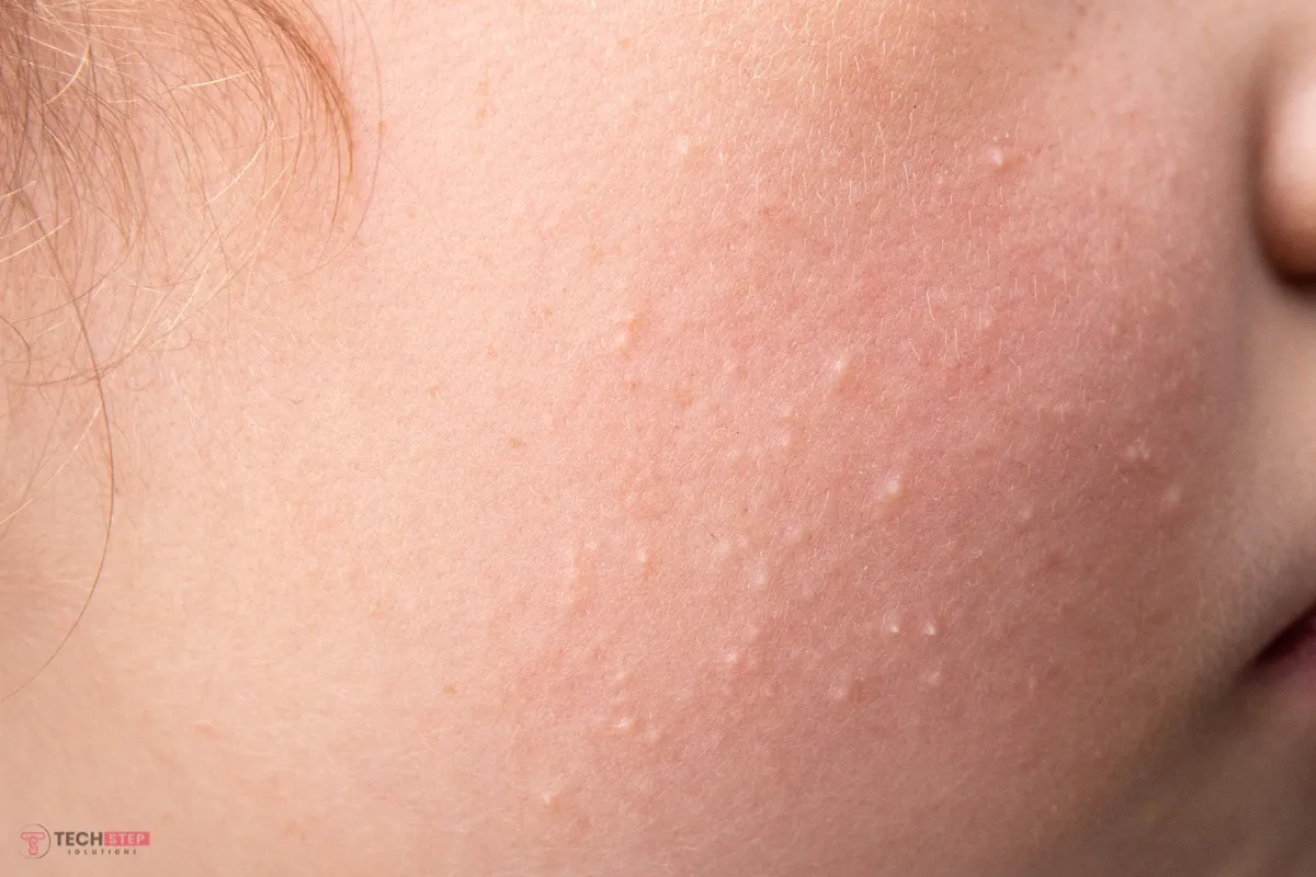 Keratosis Pilaris Treatment Cost