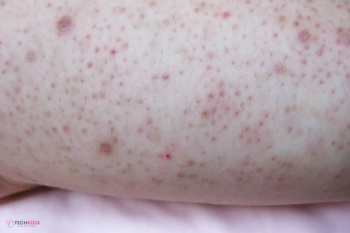Keratosis Pilaris Treatment in Lake Forest, OC