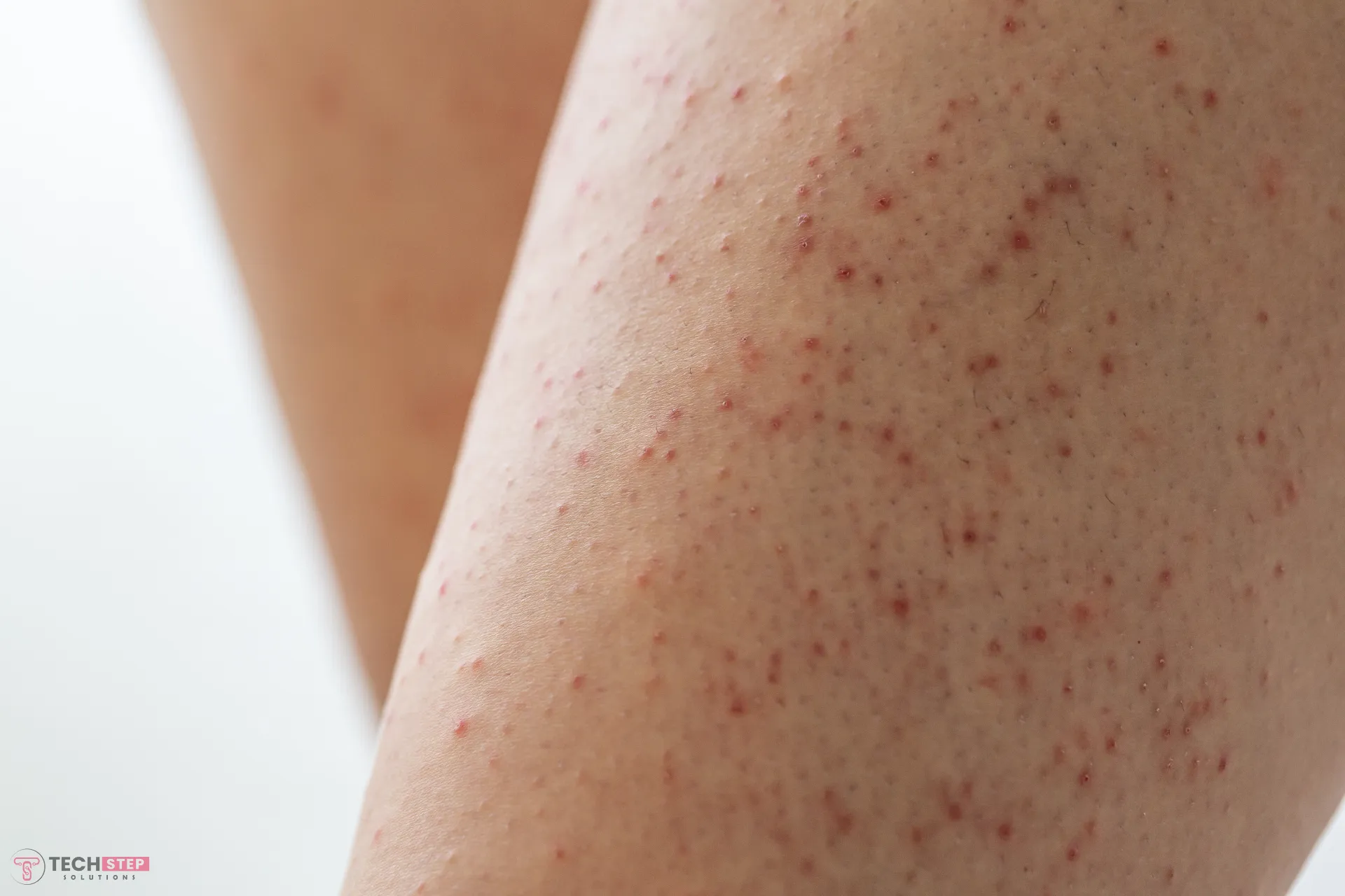 Keratosis Pilaris Treatment